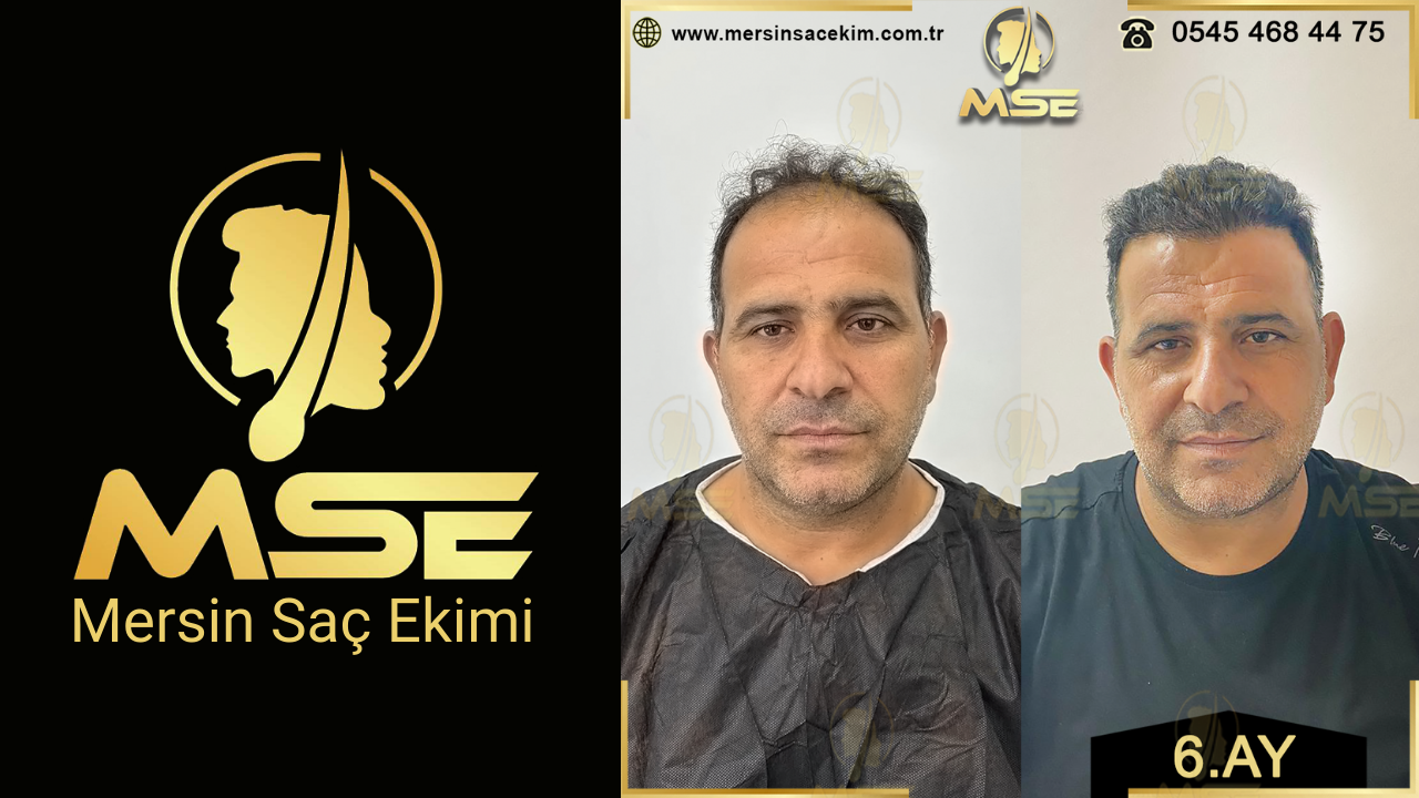 Mersin Saç Ekimi
